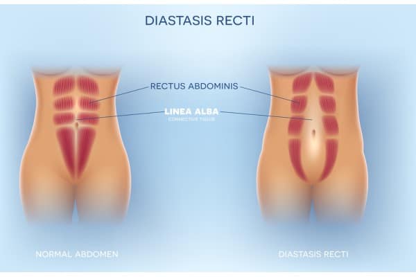 What Non-Surgical Options Are Available for Diastasis Recti Anderston?