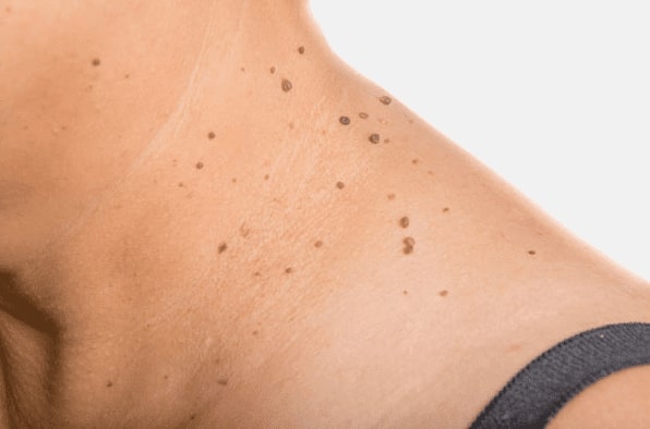 Are you looking for easy skin tag removal Anderston - then contact Spire today!