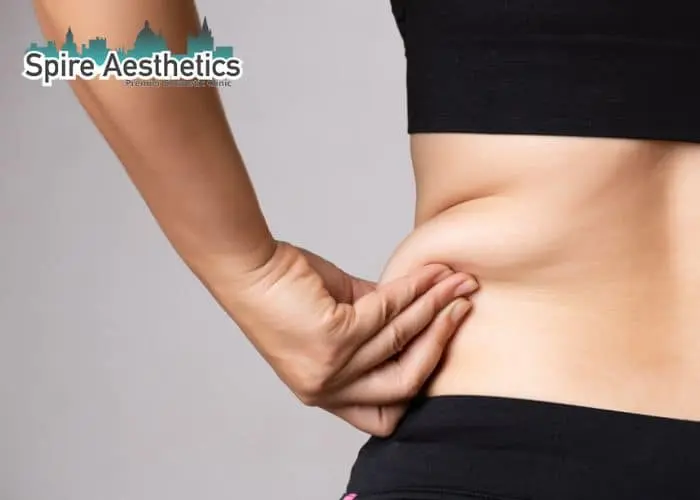 Image of woman pinching fat on their hips Anderston. Fat Freezing treatment