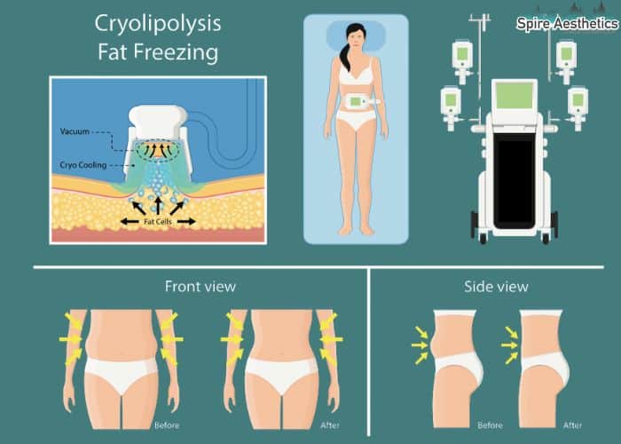 Image of diet and fat freezing combined for best results for Spire Aesthetics Anderston